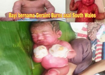 Lahir Dengan Kondisi Kulit Mengering dan Memerah, Akhirnya Bayi Pasutri warga Desa Baru Dirujuk ke RSU Bangkinang